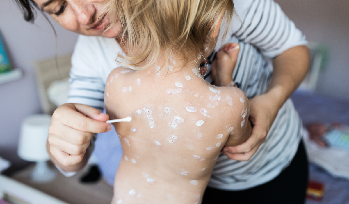 Val de cazuri de varicelă la adulți în 2026. De ce boala „copilăriei” a devenit un pericol letal la maturitate